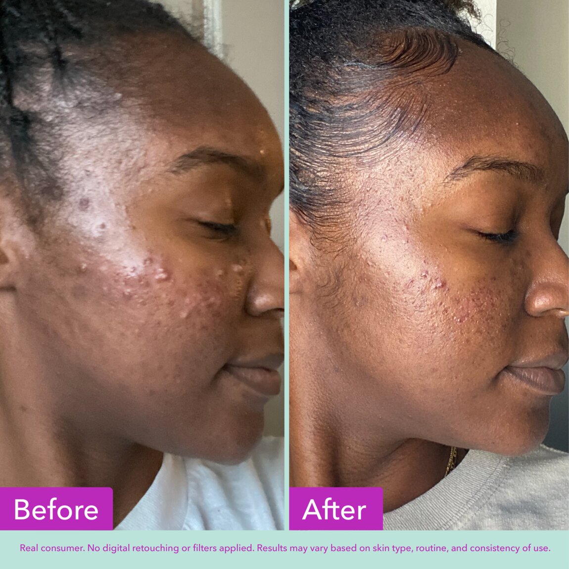 acne-foaming-cleanser-u9 zb_p.jpg